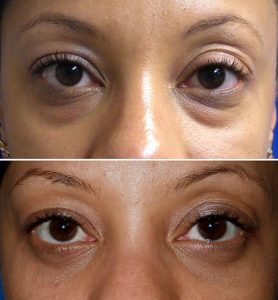 2016-eyelid-surgery-photo